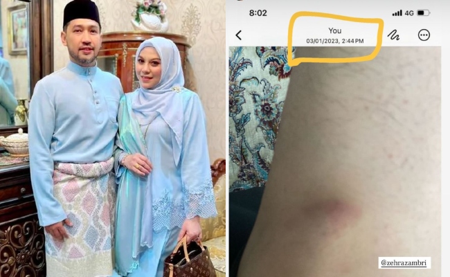 Adik Zehra Zambri Kongsi Foto Lebam, Dakwa Berlaku Ketika Dalam Pantang? – ‘Makin Dinafi, Makin Banyak Aib Kau Sendiri Terkeluar’
