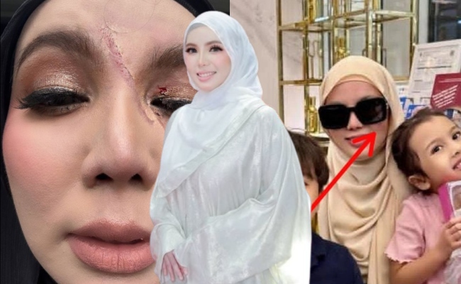 Tular Foto Keadaan Terkini Wajah Cik Epal, Dr. Raihana Tak Sangka Jadi Makin Teruk – ‘Ambil Sedikit Masa Untuk Sembuh’