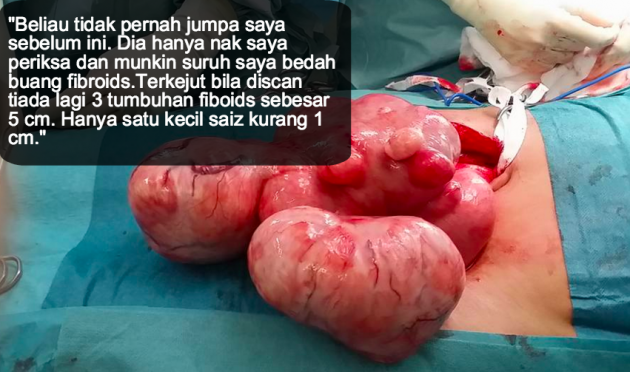 Download 5300 Gambar Fibroid Rahim Terbaik HD