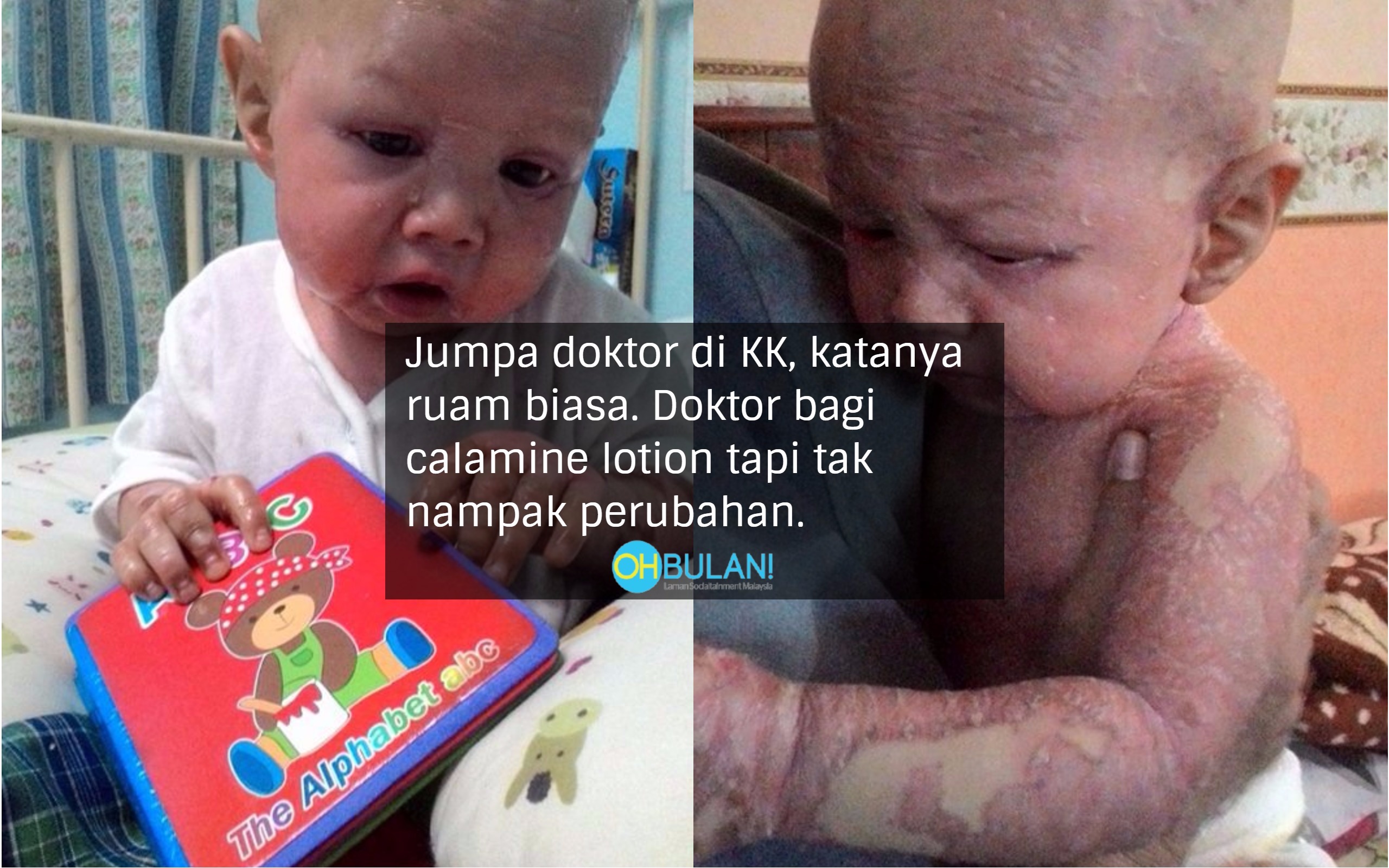 Dinasihat Jangan Guna Ubat Hospital, Akhirnya Kulit Anak Makin Teruk..