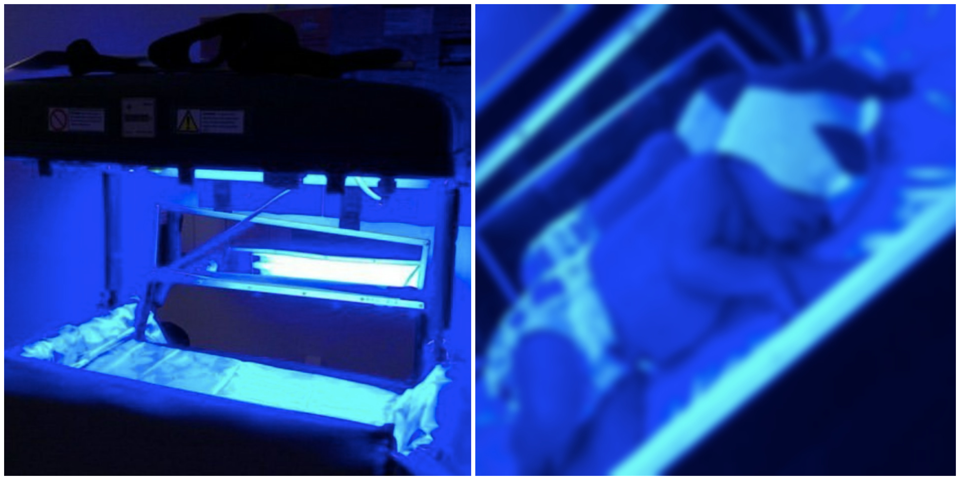 Netizen Berbalah Isu Penggunaan 'Lampu Biru' Untuk Merawat 