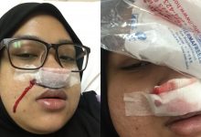 ‘Bersin Pagi-Pagi, Pening Kepala’ – Wanita Jalani Pembedahan Resdung Selepas Hilang Deria Rasa & Bau