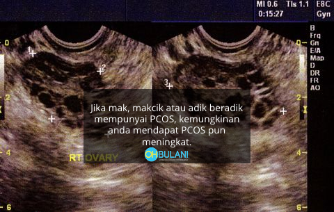 Haid Tidak Teratur & Sukar Hamil, Ini Sindrom Ovari Polisistik (PCOS) Dalam Kalangan Wanita